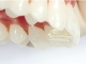 Preview: Embouts de remplacement pour MiniMold Tiger Dental (bloc d'occlusion palatin)