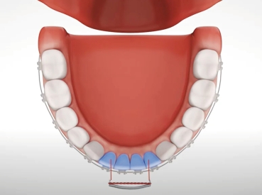 Matériau de couronne temporaire dentaire pour dents antérieures molaire 1  boîte