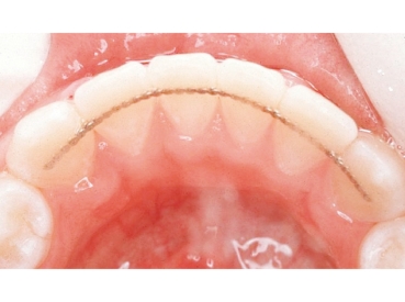 50 Pièces/Boîte Couronne Temporaire Dentaire pour Dents Antérieures,  Couronnes Dentaires Temporaires pour Dents en Porcelaine, Couronne Molaire