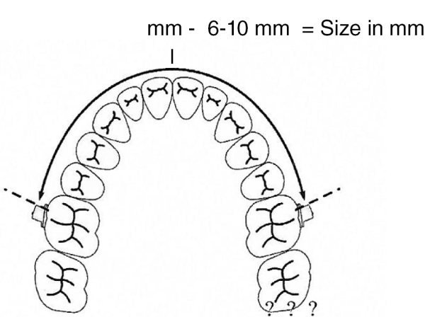 Arc de distalisation pour molaires, taille 3 (86 mm)